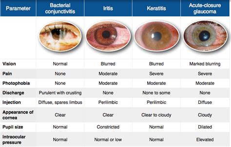 Red Eye Differential Diagnosis Medizzy